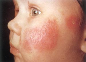 Dermatitis Atopica niño