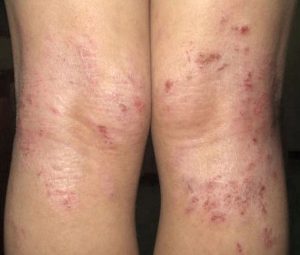 Dermatitis Atopica piernas