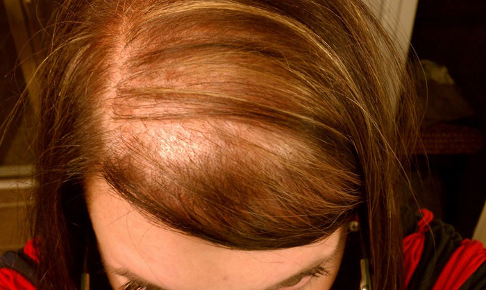 alopecia caida del pelo