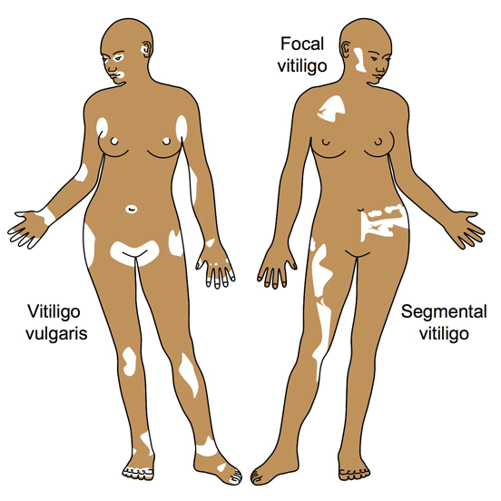 vitiligo-types